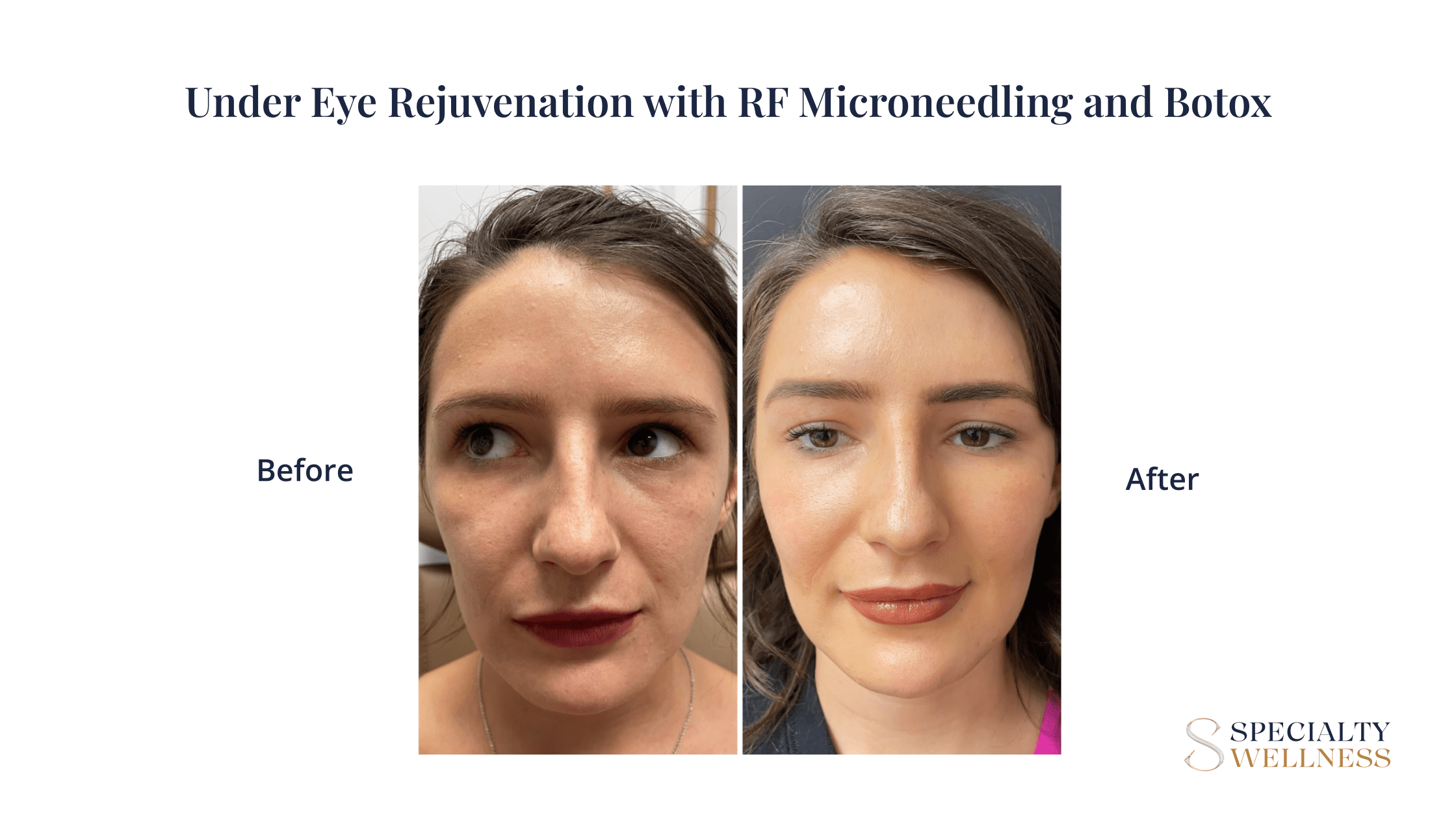 Under Eye Rejuvenation with RF Microneedling and Botox